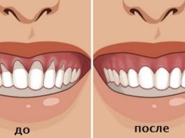 Вы заметили оголение шейки или корня зуба? Немедленно начинайте лечение — 6 натуральных рецептов!