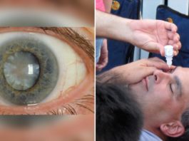 Появились глазные капли, которые могут растворить катаракту