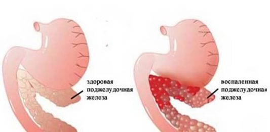 От поджелудочной может быть температура. Панкреатит симптомы. Острый панкреатит поджелудочной железы. Профилактика заболеваний поджелудочной железы. Заболевания поджелудочной железы список.