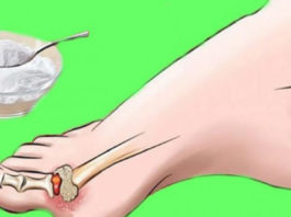 Как удалить кристаллизацию мочевой кислоты из Вашего тела, чтобы предотвратить подагру и боли в суставах